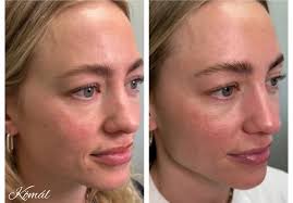 How Often Should You Get Botox?