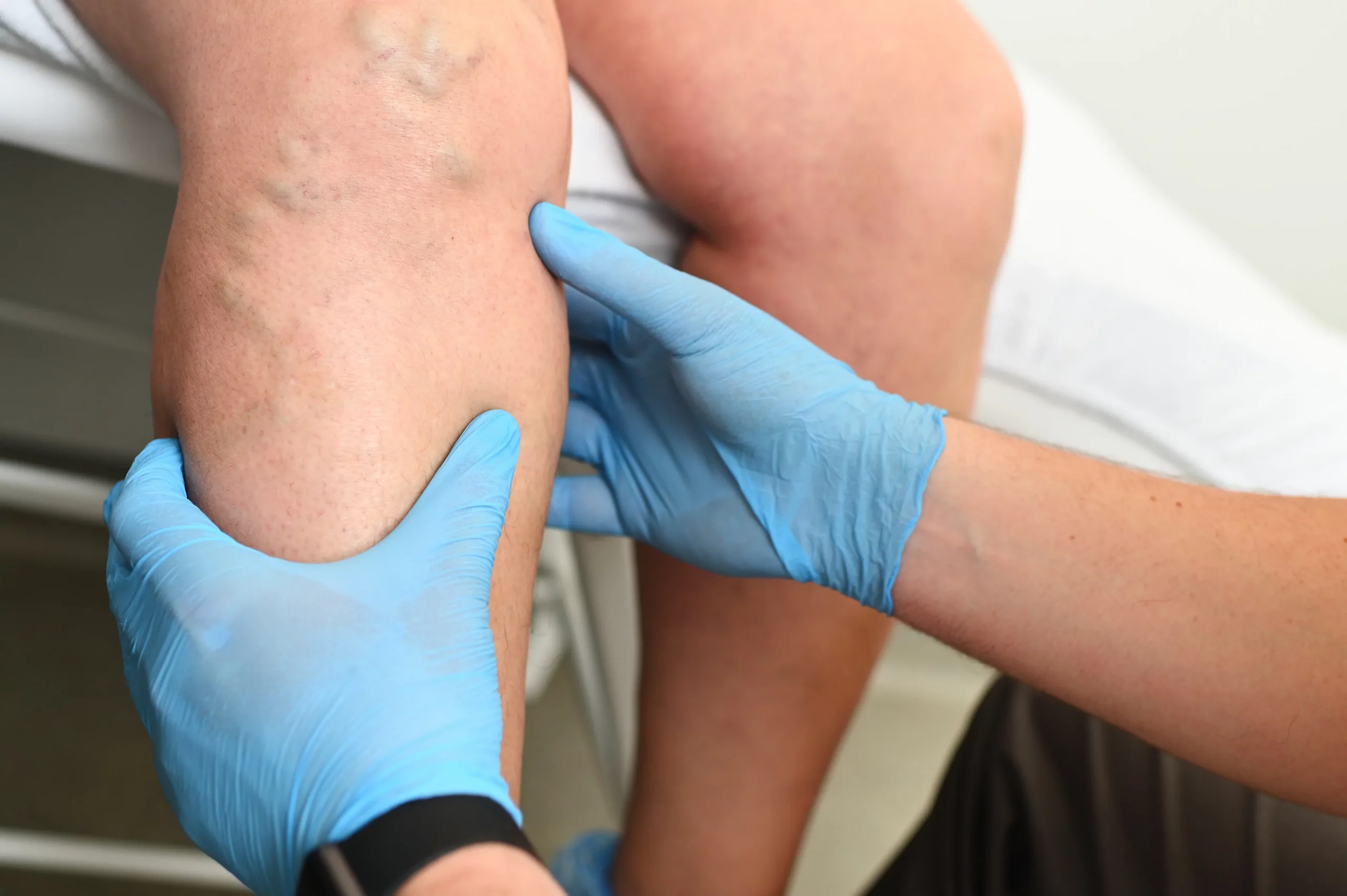 How to Prevent and Treat Varicose Veins Naturally