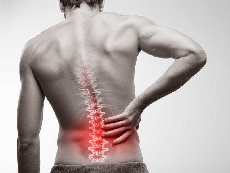 What Are the Long-Term Effects of an Untreated Herniated Disc?